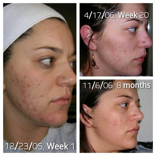 acne progress