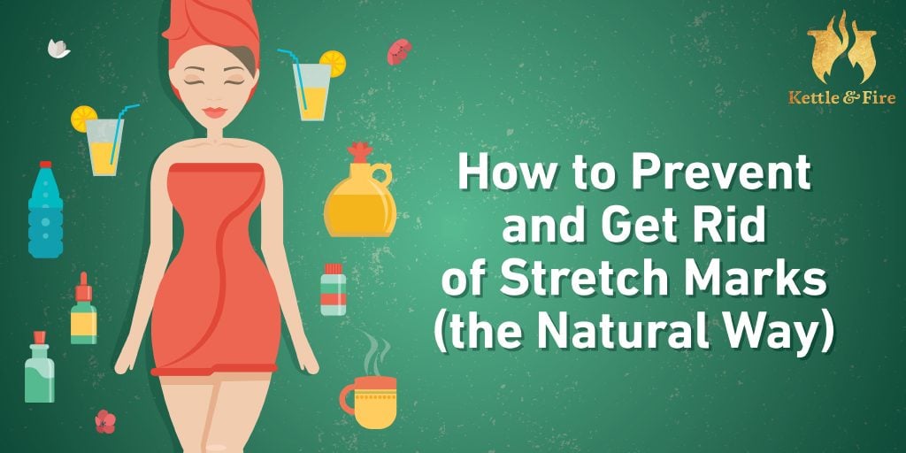 How to Prevent and Get Rid of Stretch Marks (the Natural Way)