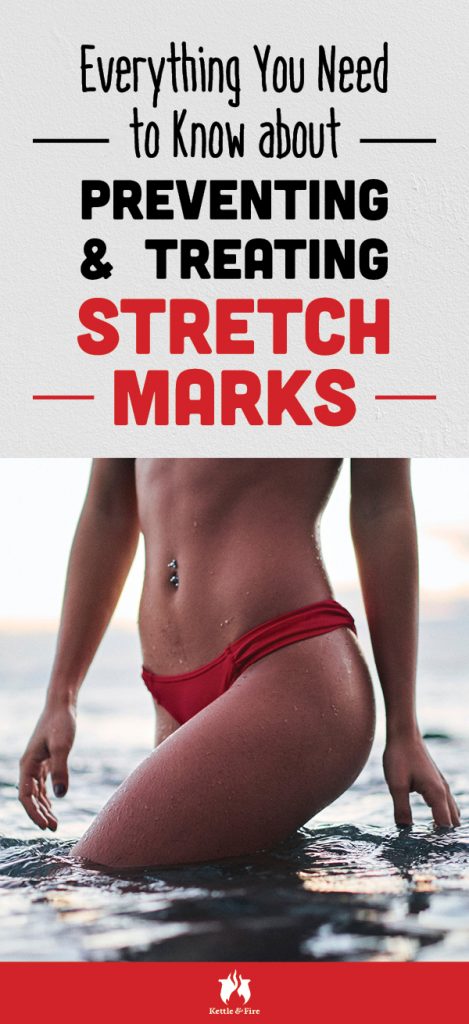 Everything You Need to Know about Preventing and Treating Stretch Marks pin